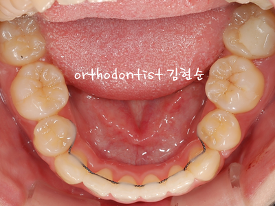 치열 교정(치열 불규칙) 관련 이미지 27