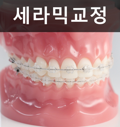 세라믹교정 잘하는 곳은? 세라믹치과 관련 이미지 9