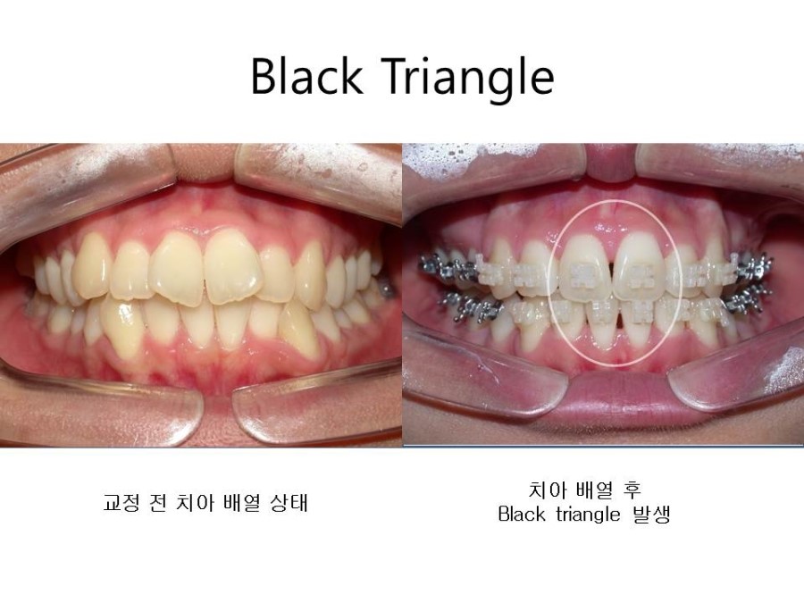 학동역치과 치아교정 잘하는 곳 ! 관련 이미지 27