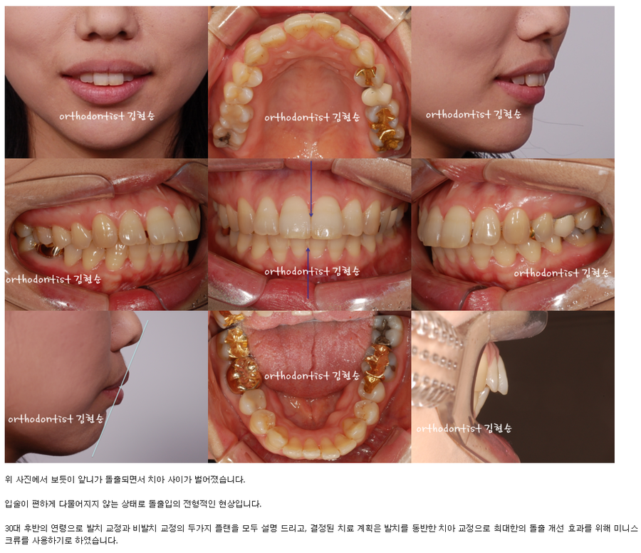 세라믹교정 세라믹치과-돌출입발치교정 10 관련 이미지 3