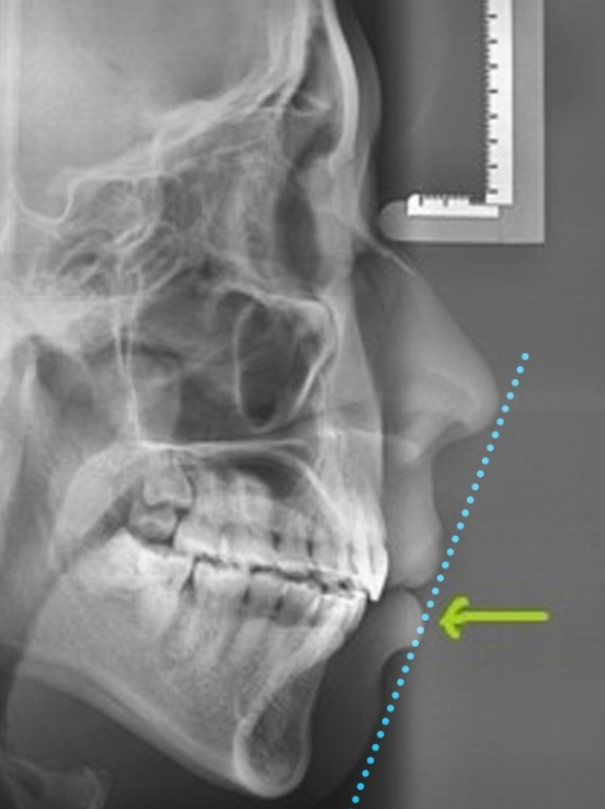 세라믹치과 돌출입교정 투명교정기로 ~ 관련 이미지 7