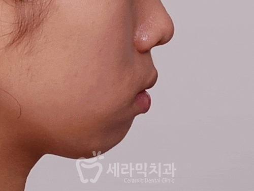 돌출입교정만 했을 뿐인데, 얼굴형과 무턱까지 개선된 치아교정전후 관련 이미지 4
