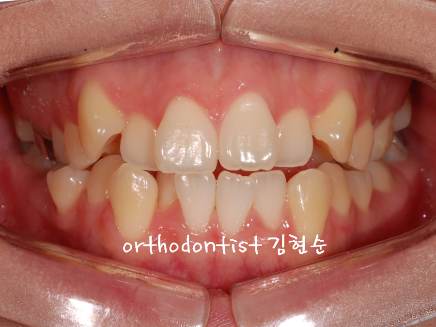 세라믹교정 은 관련 이미지 2