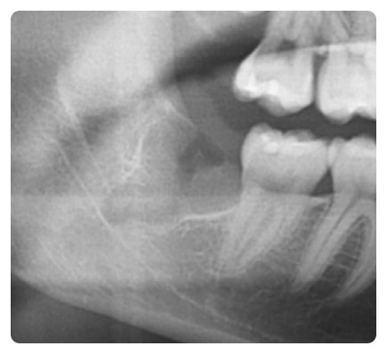 학동역 사랑니발치 관련 이미지 2