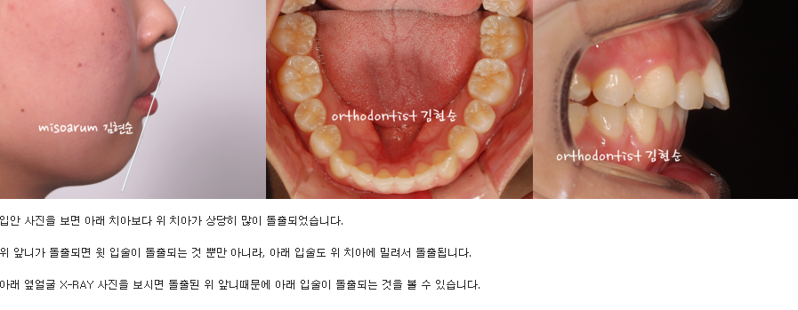 세라믹교정 세라믹치과-돌출입발치교정 2 관련 이미지 2