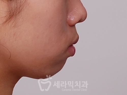 돌출입교정만 했을 뿐인데, 얼굴형과 무턱까지 개선된 치아교정전후 관련 이미지 2