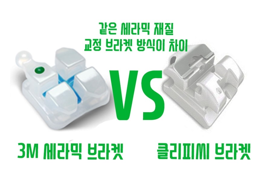 클리피씨교정 기간 짧을까? 관련 이미지 10