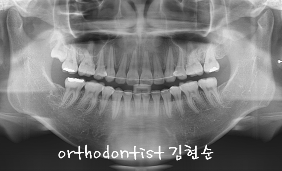 강남 돌출 관련 이미지 37