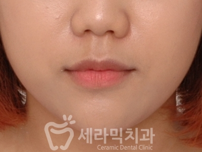 돌출입과 개방교합 치아교정 치료전후 관련 이미지 12