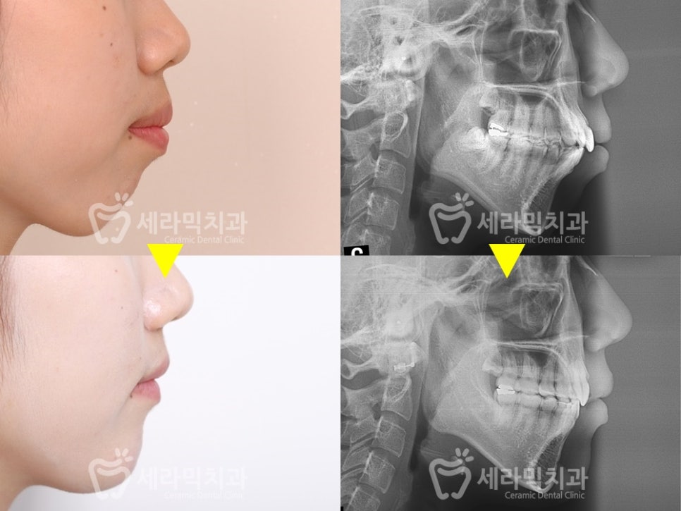 돌출입교정 치아교정전후(비수술, 발치교정) 영상 관련 이미지 1