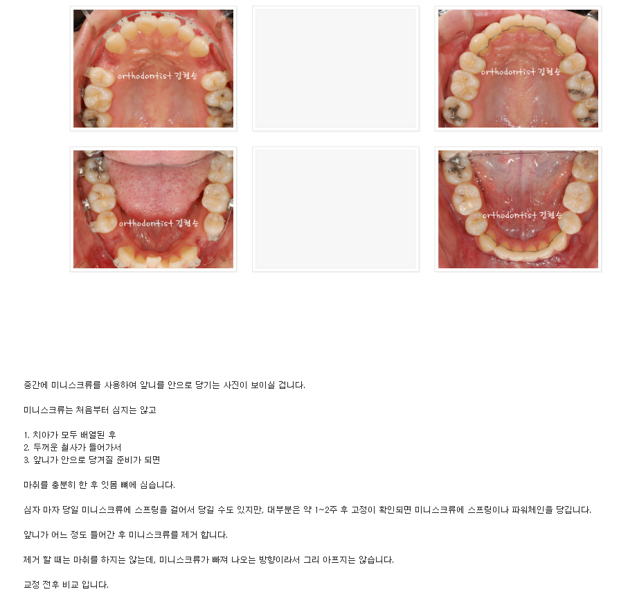 세라믹교정 세라믹치과-돌출입 발치교정 11 관련 이미지 4