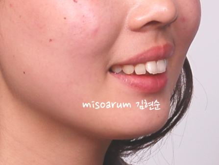 강남 돌출입 교정 관련 이미지 36