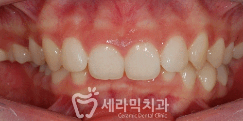 과개교합 치아교정 전후 올라간 입꼬리! 관련 이미지 3