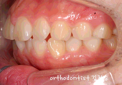 강남 돌출 관련 이미지 12