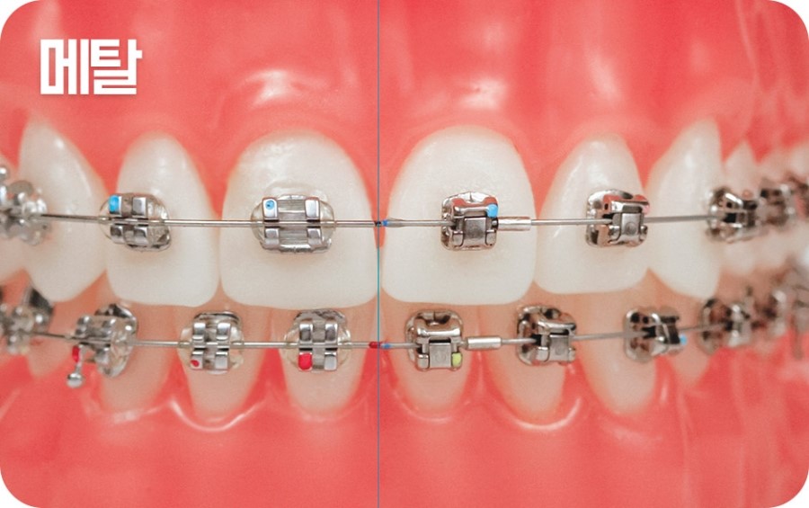 교정장치 구분하기 관련 이미지 10