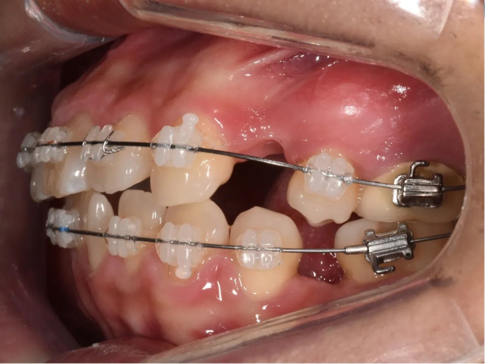 돌출입 교정 전후, 그런데 과개교합까지 있으셨던 환자분 관련 이미지 14