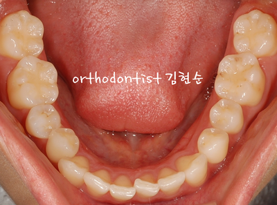 돌출 교정 (비발치 교정/비대칭) 관련 이미지 6