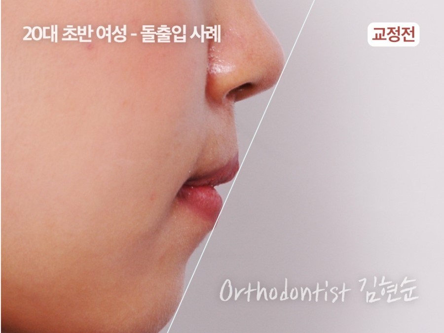 클리피씨교정 기간 짧을까? 관련 이미지 15