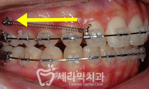 과개교합, 딥바이트 비발치 치아교정전후 관련 이미지 5