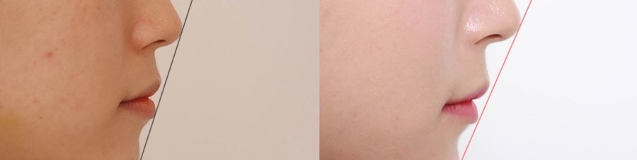 세라믹치과 돌출입교정 해결하기 관련 이미지 3