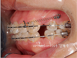 강남 돌출입 교정 관련 이미지 32