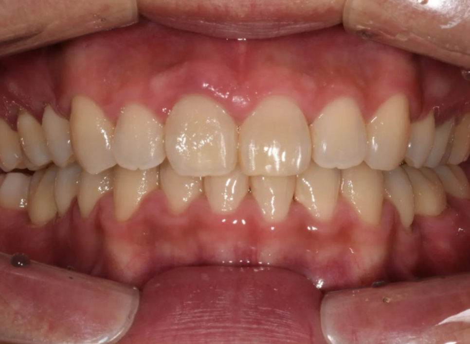 돌출입 교정 전후, 그런데 과개교합까지 있으셨던 환자분 관련 이미지 19