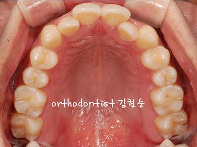 반대교합 관련 이미지 5