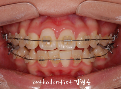 강남 돌출 (토끼 치아) 관련 이미지 18