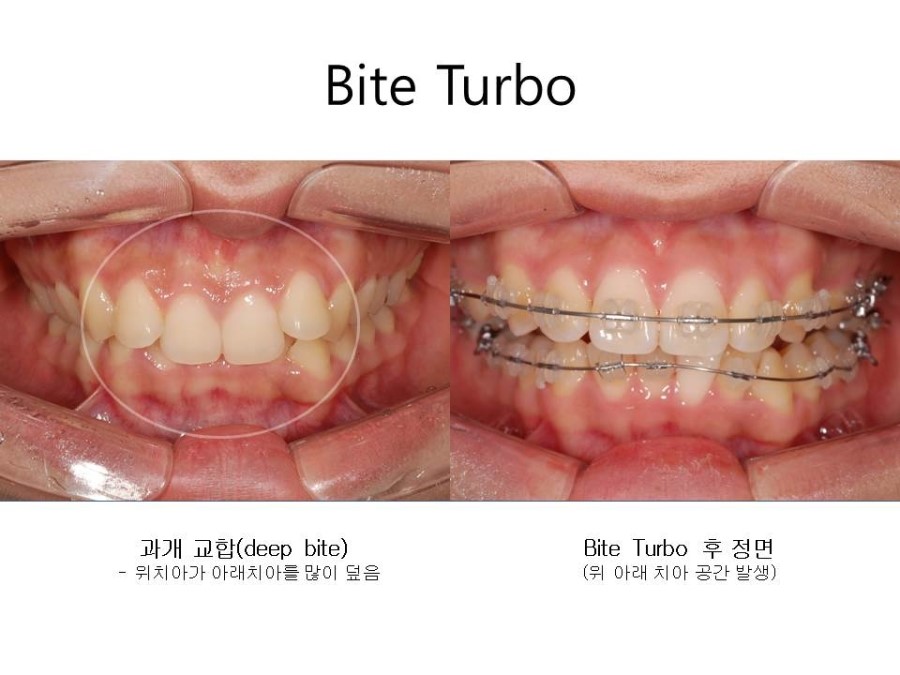 학동역치과 치아교정 잘하는 곳 ! 관련 이미지 13