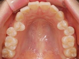 세라믹교정 세라믹치과 - 아나운서 교정이 뭘까요 ? 관련 이미지 4