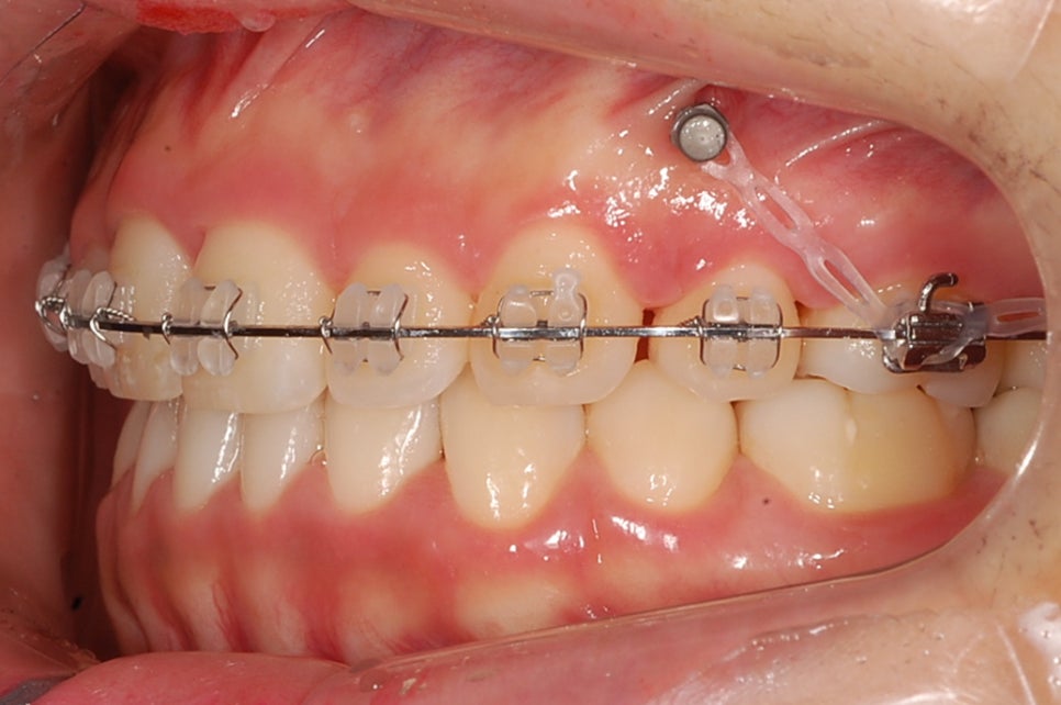 교정 스크류 관련 이미지 1