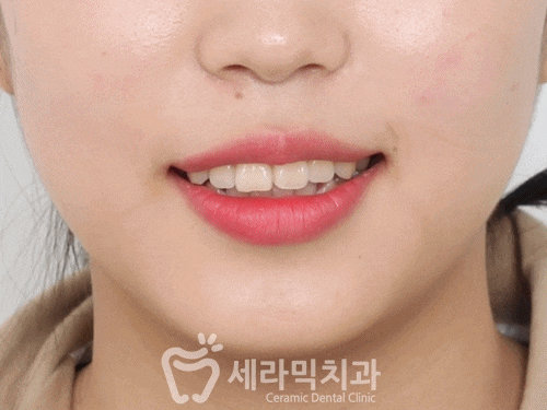 치아교정전후 사진영상. 돌출입교정하고 더 예뻐지자! 관련 이미지 2