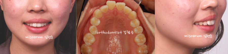 비발치교정 스트리핑이 필요 관련 이미지 3