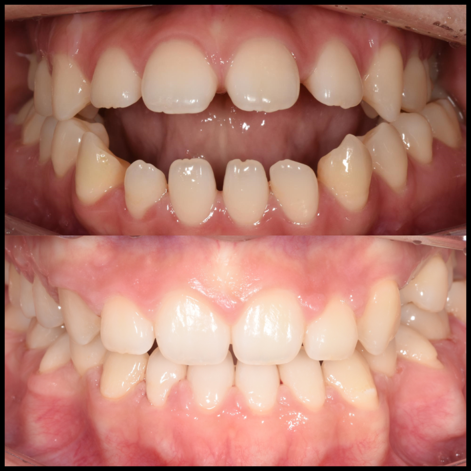 학동역 교정치과, 개방교합과 비대칭을 수술없이 교정한 경우 관련 이미지 15