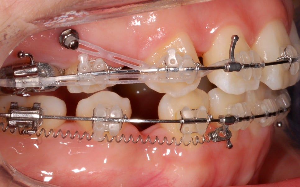 개방교합은 재발률이 높다? 치아교정 후 관리방법 (feat.유지장치) 관련 이미지 7