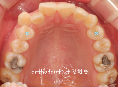 강남 돌출 (토끼 치아) 관련 이미지 14