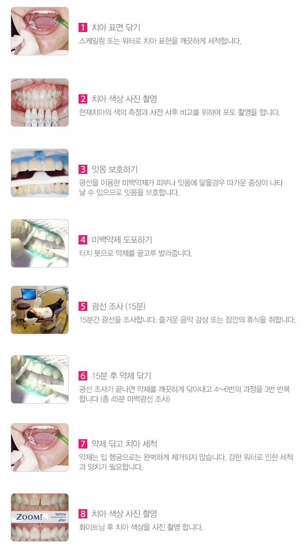 [미소아름 화이트닝] 미소치과의 화이트닝 ZOOM2 관련 이미지 5