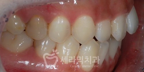 Open Bite Dental Clinic Orthodontic Before and After: Did a Long-Looking Jaw Become Shorter? image 6