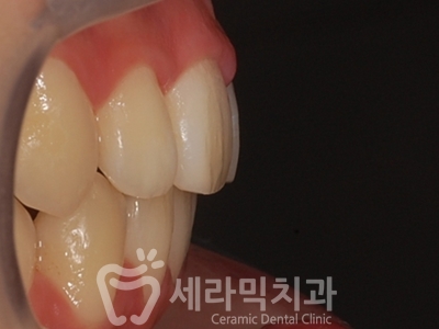 과개교합 치아교정잘하는곳, 세라믹치과 치아교정전후! 관련 이미지 28