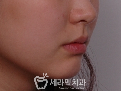 토끼이빨 돌출입 치아교정 전후 표정변화! 관련 이미지 5