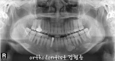 치열 교정 ( 벌어짐 ) 관련 이미지 26