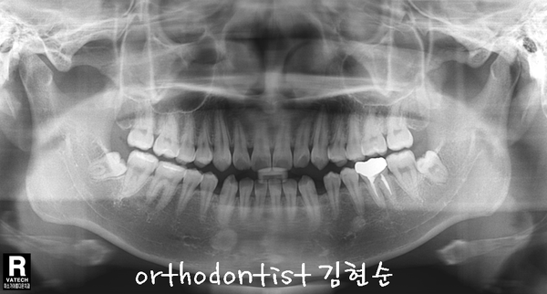 반대 교합 관련 이미지 13