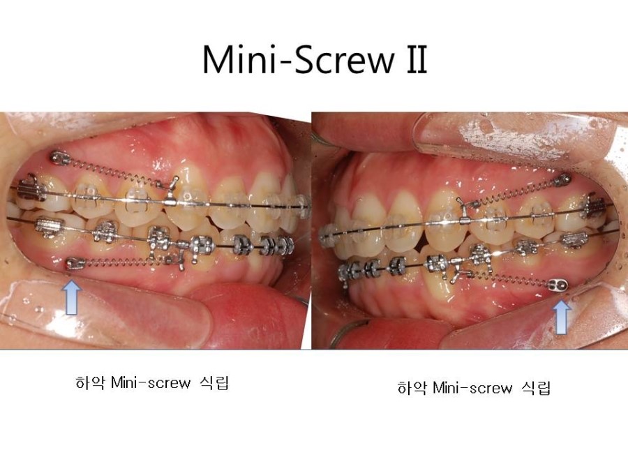 학동역치과 치아교정 잘하는 곳 ! 관련 이미지 20