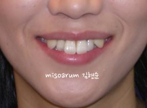 세라믹교정 덧니교정 관련 이미지 11