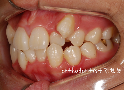 강남 덧니 관련 이미지 6