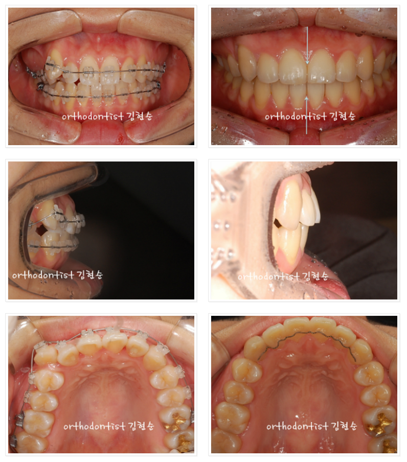 비발치로 덧니의 치열을 개선, 중심선을 맞추는 교정. 관련 이미지 3