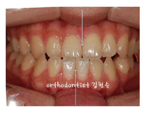 주걱턱수술 안하고 양악수술 안하고 관련 이미지 9