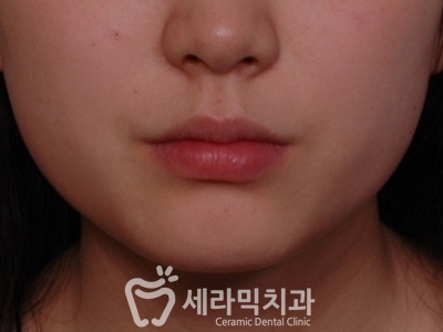 토끼이빨 돌출입 치아교정 전후 표정변화! 관련 이미지 2