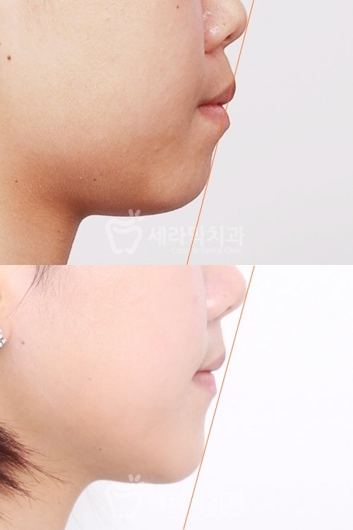학동역 치아교정, 수술없이 예뻐져도 되나요? [돌출입교정 전후 달라진 외모] 관련 이미지 2