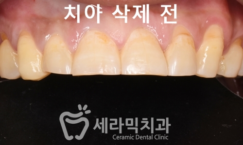 치아교정과 라미네이트는 선택이 아닌 상호 보완관계! 관련 이미지 6